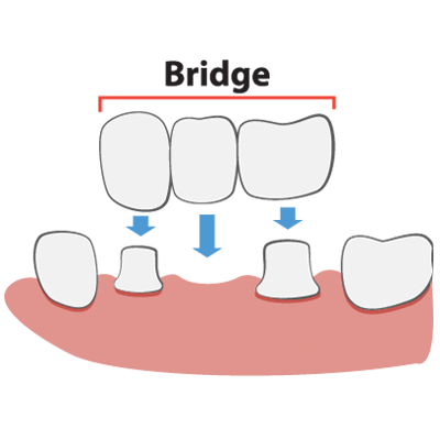 Dental Bridge Graphic