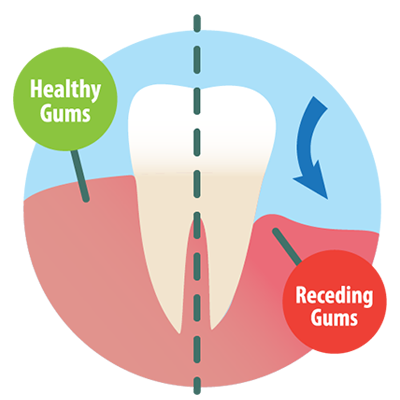 Receding Gums