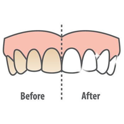 Teeth Whitening Graphic
