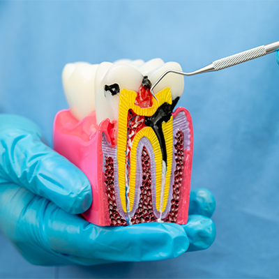 Demonstrating a tooth anatomy model for a root canal.