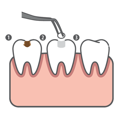 TOOTH COLORED FILLINGS GRAPHIC