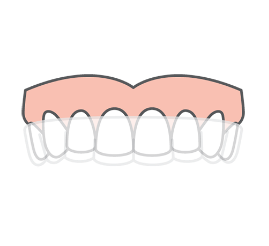 Clear Aligner Illustration